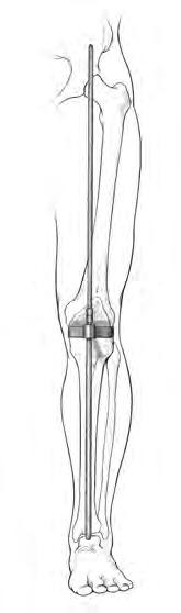 33 NexGen LPS Fixed Bearing Knee Surgical Technique Figure 63 Figure 64 Flexion/Extension Gaps (cont.