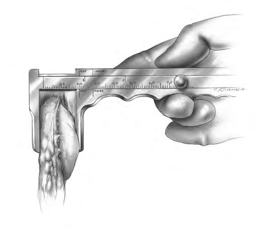 41 NexGen LPS Fixed Bearing Knee Surgical Technique Figure 77 Step Eleven: Prepare the Patella Sharply dissect through the pre-patellar bursa to expose the anterior surface of the patella.