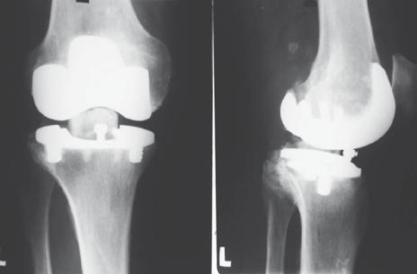 The main cause for primary implant failure was the wear of polyethylene surface. (Fig. Nr.9.10.).
