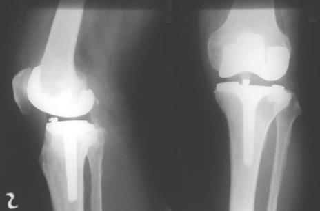 We also used this type of prosthesis in the right knee of our patient for primary TKR.