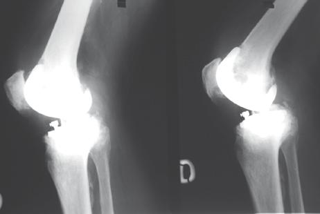 knee 4 years and ten months after primary TKR.
