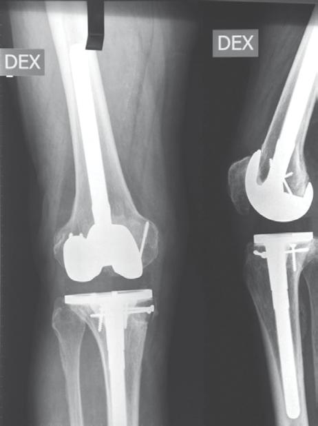 2001 revision TKR (J&J) in left knee due to