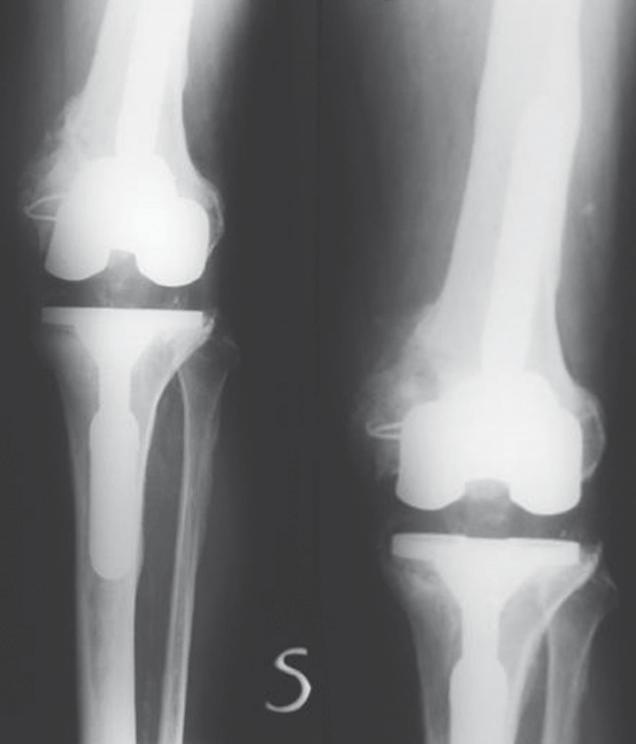 Aseptic loosening of both right knee prosthesis