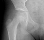Hip Conditions in the Young Athlete Fracture/Dislocation Sprain/Strains Snapping Hip Hip Impingement Labral Tears Arthritis Athletic Pubalgia Neoplasm Soft Tissue/Overuse Osteonecrosis