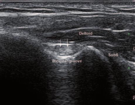2 Pitfalls in Musculoskeletal Ultrasound 23 Pitfalls Due to GS Artifacts Artifacts Due to Transducer Position Anisotropy, according to Wikipedia [14], is the property of being directionally