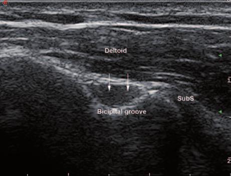 Dynamic evaluation of the tendon s movements can also help ruling out tears. Bone pseudodefect is another artifact linked to the position of the probe in relation to the bone contour.