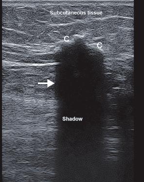 2 Pitfalls in Musculoskeletal Ultrasound 29 Fig. 2.9 Transverse view of the gluteal region in a scleroderma patient. A big calcification ( C) is seen in the subcutaneous tissue.