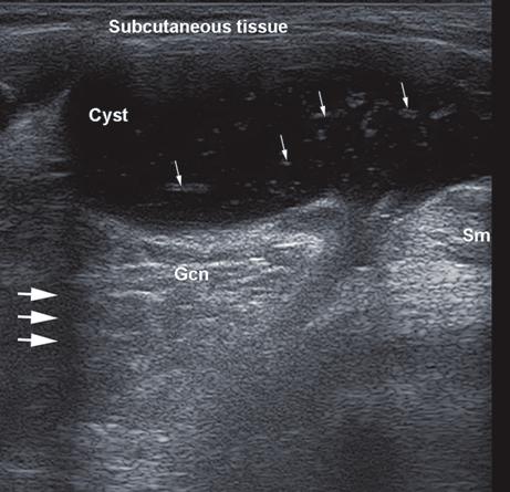 Refractile shadowing also appears in case of tendon full-thickness tears, and sometimes it might be the only US sign of the tear.