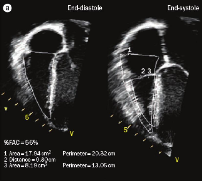 ISRN Pediatrics 3 (a) (b) (c) (d) (e) (f) Figure 1: Assessment of right ventricular (RV) function by echocardiography. (a) %FAC, calculated from measures from the apical fourchamber view.