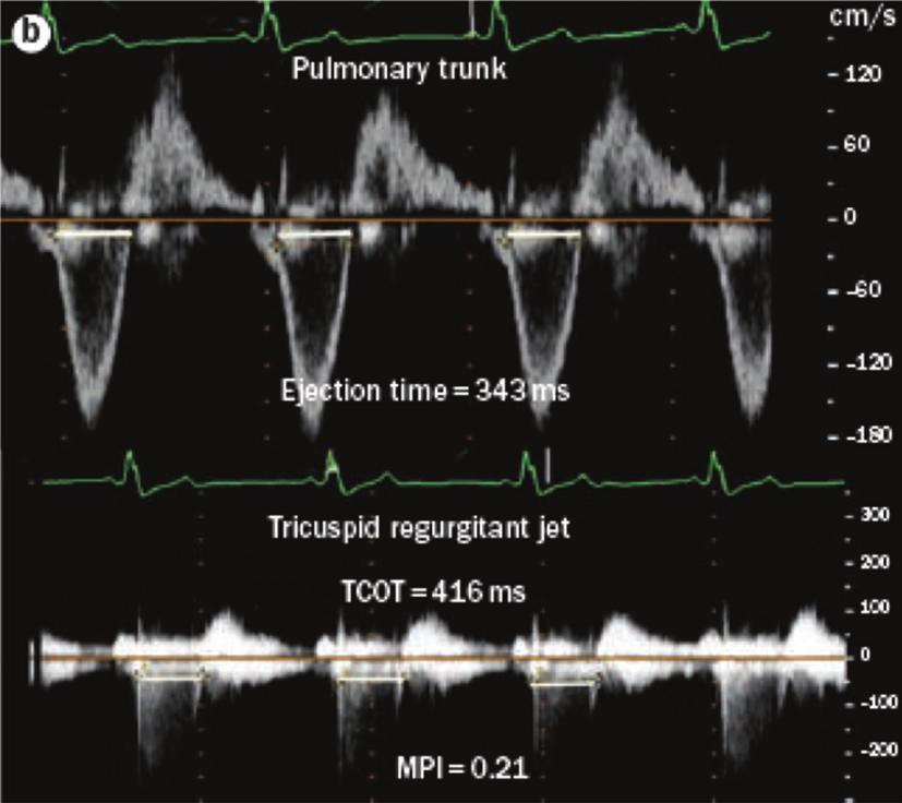 (b) MPi, calculated by measuring the ejection time on the pulmonary artery tracing and the time between closure and opening of the tricuspid valve on the tricuspid inflow tracing.