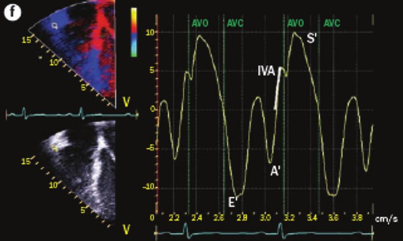 The timing of these events may be taken as that of pulmonary valve opening and closure. The slope of iva is shown.