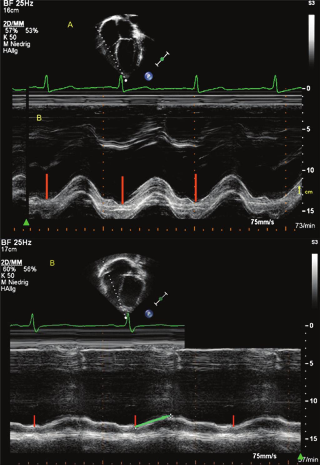 ventricular function. the presence of defined onset and end of MR/TR on spectral Doppler tracings. 8.