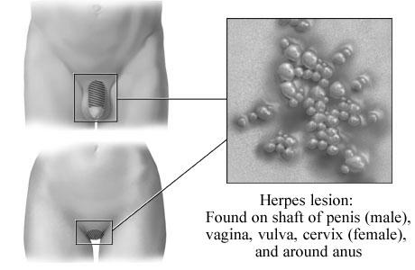 Overview of herpesvirus