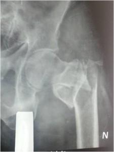 with traction xray showing no anatomical
