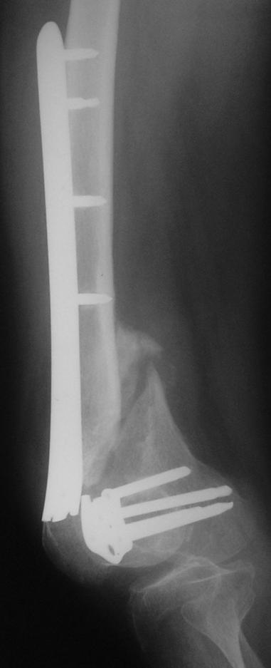 A1 fractures.