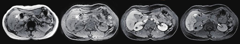 However, even these classical signs can sometimes be lacking for anatomic or technical reasons, and moreover malignant tumors can present with the spoke-wheel sign.