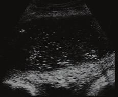 period of 2 months [2]. a) b) c) Figure 2 a and b) Computed tomography. c) Chest ultrasound.