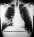 Pneumonia Update 2010 Management of the Hospitalized Patient Scott A. Flanders, M.D.