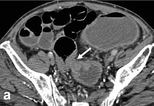 In the remaining 6 patients with obstructive lesions distal to the splenic flexure, 4 patients (66.67%) showed total obstruction.