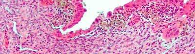 Hormones and inflammation:endometriosis Estrogens Progesterone Cytokines Chemokines Free radicals (Oxidative stress) Prostaglandins + - Endometrial cell Cell proliferation