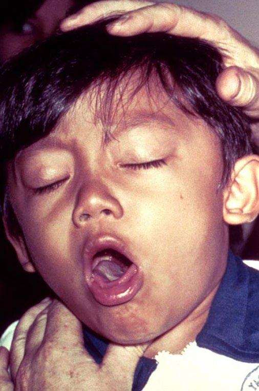 Clinical presentation of pertussis in infants and young children Infants may not make the whoop sound after coughing, but they may start gagging or gasping and may