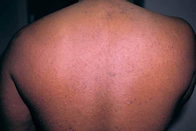 Dermclinic Continued Case 4: A 31-year-old man seeks evaluation of a pruritic papular eruption on his trunk