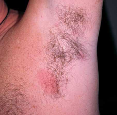 When the folliculitis did not improve after 1 week of treatment, a bacterial culture was performed; Pseudomonas aeruginosa, D, was identified.