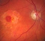 Online Webinars AGE RELATED MACULAR DEGENERATION OFTEN REFERRED BY RETINAL SURGEON Density of Cataract Reduces Visualization Quality of OCT and FA Poor