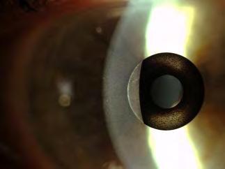 With Inlay Inlay Shinagawa LASIK Center KAMRA corneal inlay (cont.): The central aperture increases the depth of field.