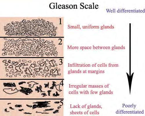 Tumor Grade: describes how much the tumor tissue looks like healthy tissue when viewed under a microscope.