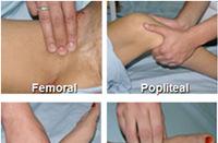 Clinical Evaluation of Acute Ischemia (Clinical Picture) Signs of acute ischemia 5Ps Pain: symptom + Palpation Pale Pulseless Parathesia Paralysis Palpate peripheral pulses, compare with