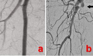 DO ANGIOGRAPHY Value of angiography Localizes the obstruction Visualize the arterial tree &