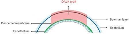 AVAILABLE TISSUE TYPES WORKSHEET: PROCESSED TISSUES Acronym Description Visual representation (when applicable) DALK Deep Anterior Lamellar Keratoplasty: DALK graft consists of anterior layers of the