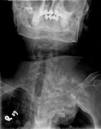 218 Primary osteosarcoma of the spine 1a 1b Figure 1. Chest radiograph a. and anterior-posterior cervical radiograph b.