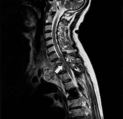 Axial T2-weighted image in T1 level reveals a mass in left side of the vertebral body, involving posterior element, epidural space, paravertebral soft tissue, and rib.