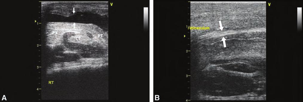 Fig. 12. (A) Anechoic fluid layer (between arrows) overlying the peroneus tertius at the level of bifurcation in a yearling with dorsal tarsal swelling.