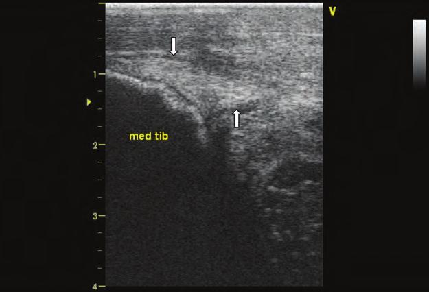 (B) Crural extensor retinaculum (longitudinal view of the retinaculum between arrows, obtained in a transverse plane over the distal tibia) in a yearling with dorsal hock swelling (same horse as in