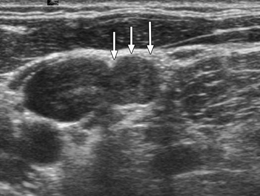change, or internal microcalcifications. The underlying sonogram in nine patients showed heterogeneous hypoechogenicity. The remaining two patients showed normal echogenicity.