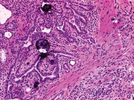 C, Sheet of papillary carcinoma shows slightly irregular nuclei with vesicular chromatin and occasional nuclear grooves (arrow).