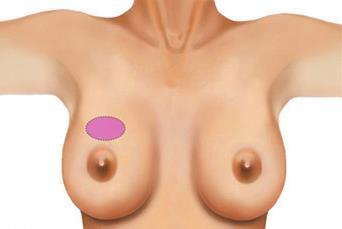 Breast cancer treatments: Surgery Goal: