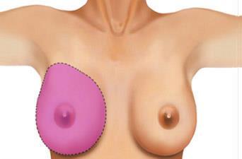 Standard: -Lumpectomy: designed to remove a