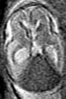 davf Arteriovenous shunts within dura 10-15% of intracranial vascular malformations 2 types: Adult: Tiny vessels in wall of thrombosed dural venous sinus