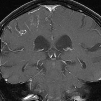 davf Imaging: MRI T2