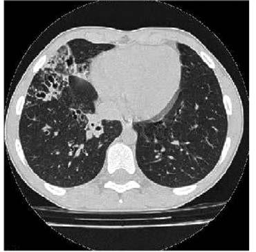 CF is a genetic, systemic disease that results in progressive lung disease and can ultimately lead to pulmonary failure 1-3 Structural lung damage may occur before spirometry detects loss of lung