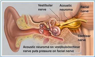Acoustic Neuroma/Schwannoma 63 Source: