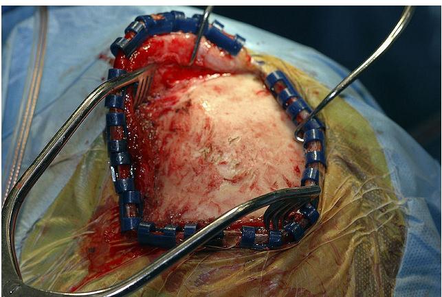 Surgeon has cut the scalp and pulled it back to expose the skull over the tumor