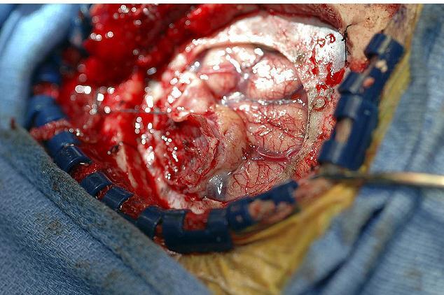 Here you see the circular cut through the dura layer with the brain and tumor