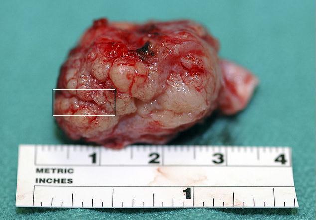 Meningioma Resected 87 Source: The Alien-a set on