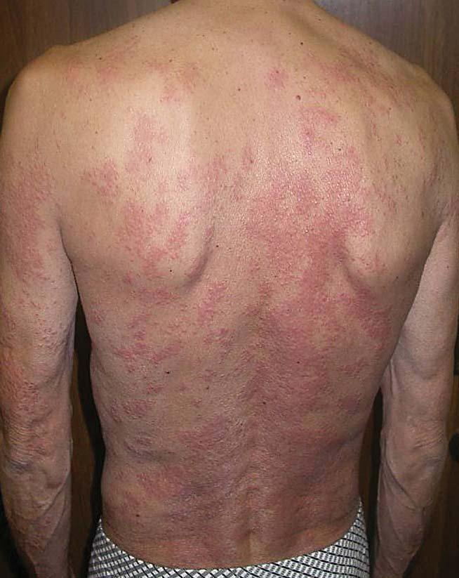 Serbian Journal of Dermatology and Venereology 2011; 3 (1): 23-26 L. Kandolf Sekulović at. al Lichenoid cutaneous sarcoidosis treated with a topical corticosteroid, without effects.