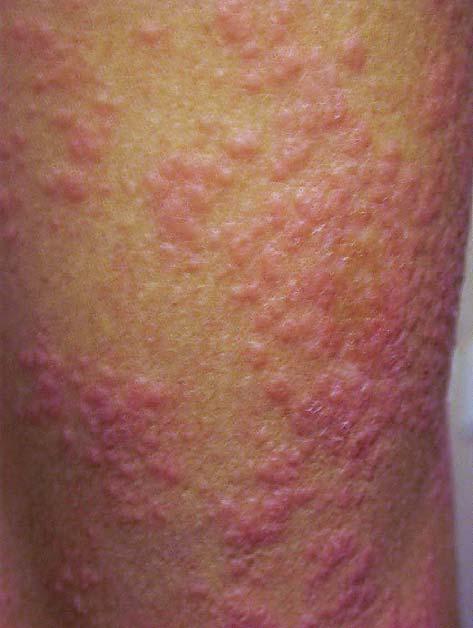 On examination, multiple livid and erythematous papules, 3-5 mm in diameter, with whitish scales, were located on the trunk and extremities, with confluence of lesions and formation of plaques and